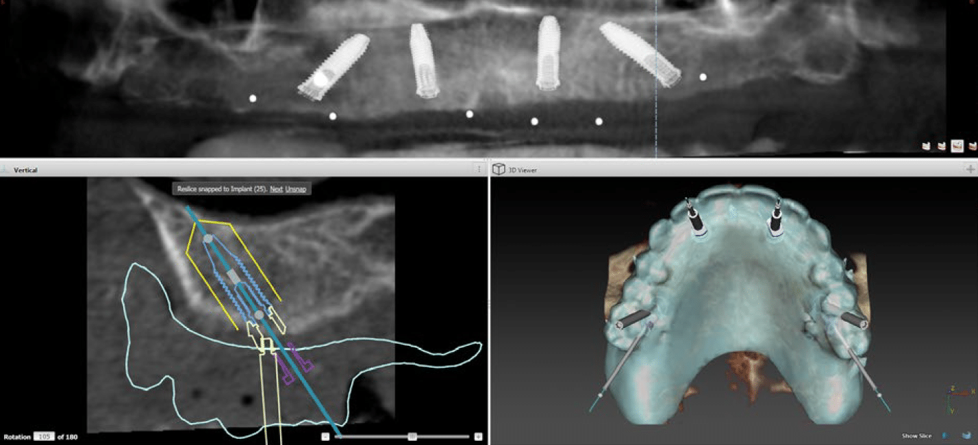 Knochenaufbau für Zahnimplantate