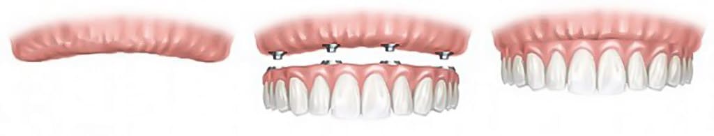 Zahnimplantat oder Brücke