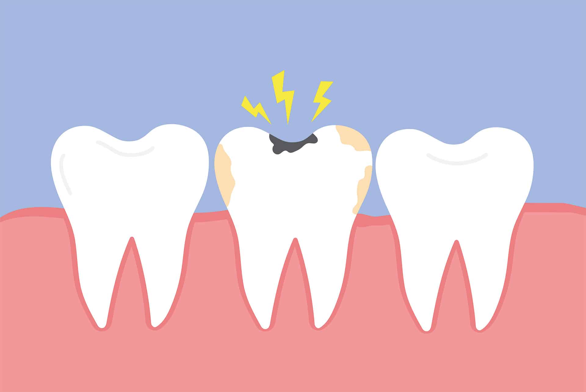 Trigeminusnerv — Ausstrahlende Zahnschmerzen durch Nervenirritation
