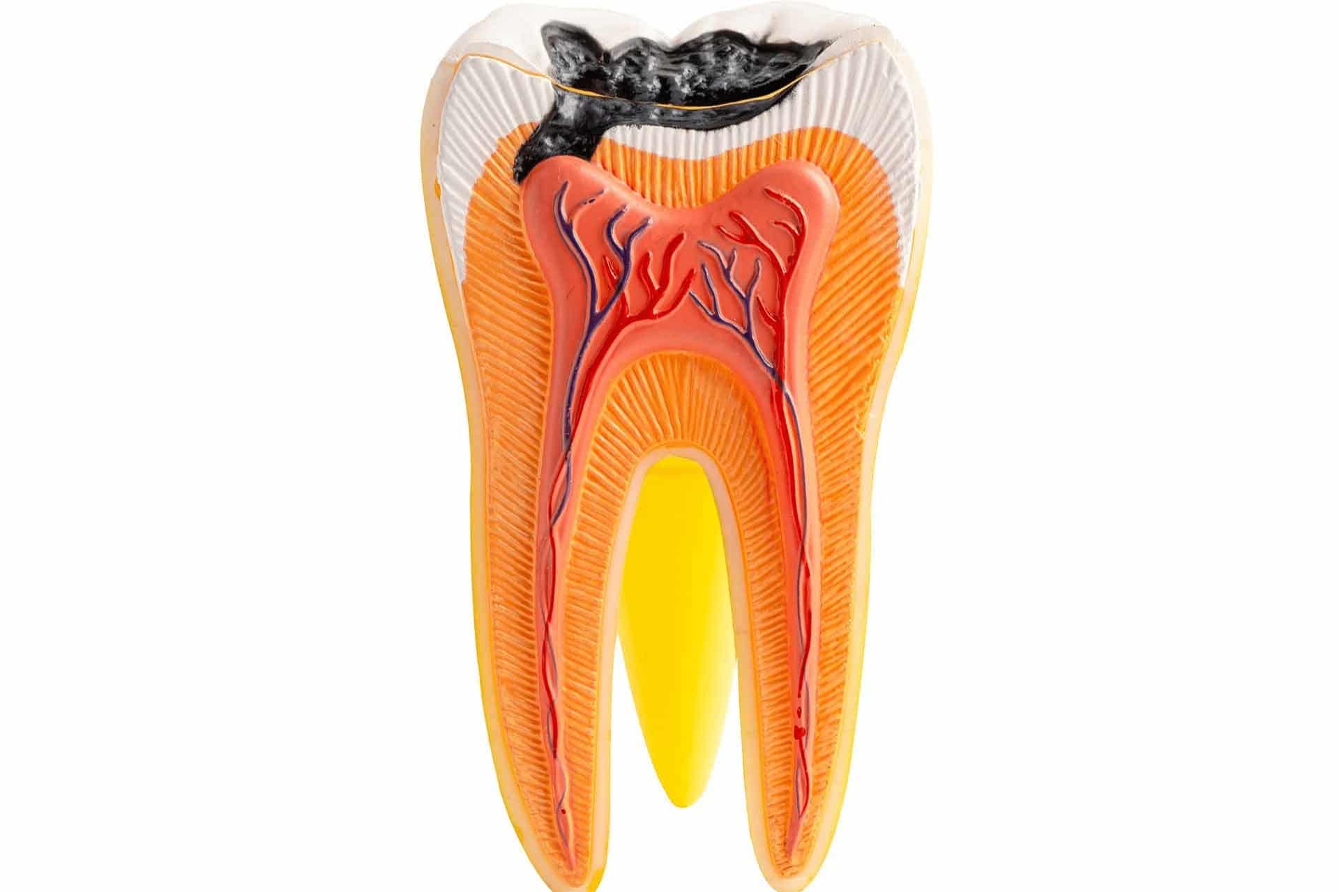 Karies am Weisheitszahn