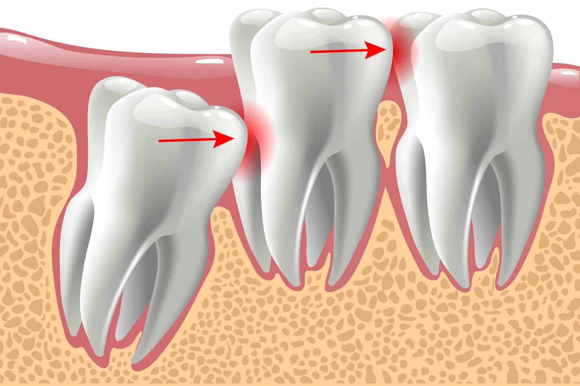Verlagerter Weisheitszahn