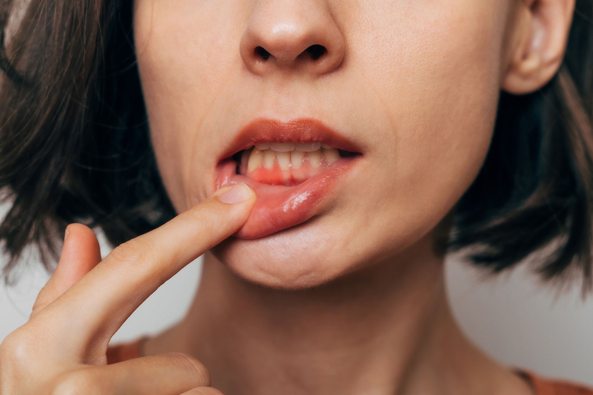 Entzündung am Zahnfleisch – mögliches Symptom einer Zyste an der Zahnwurzel
