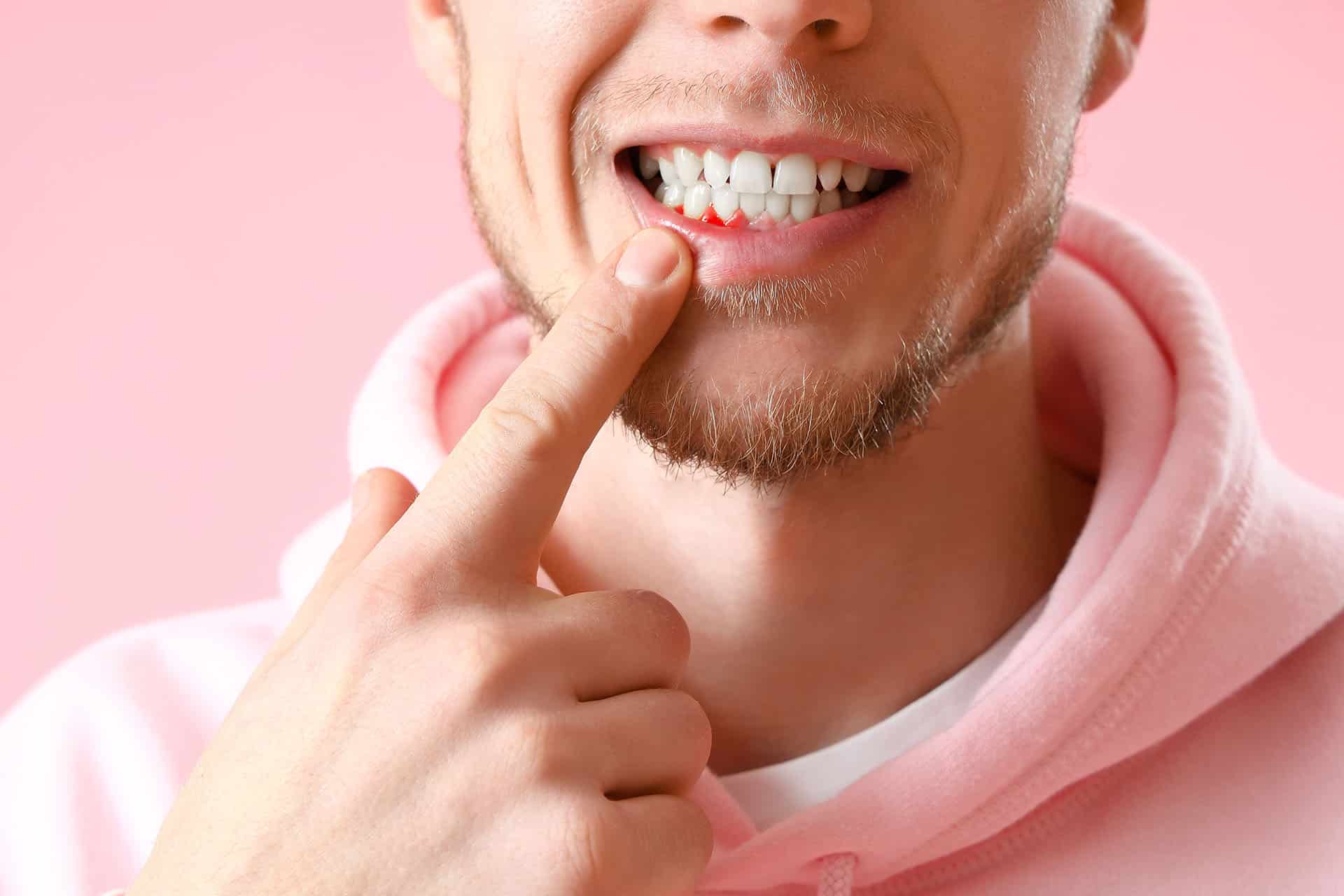 Gingivitis – Zahnfleischentzündung als häufige Ursache