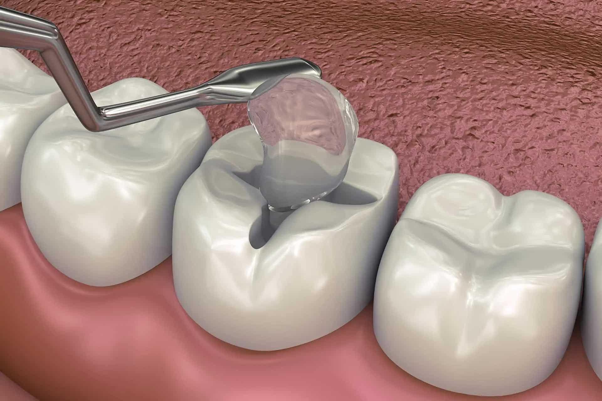 Zahnfarbene Füllungen