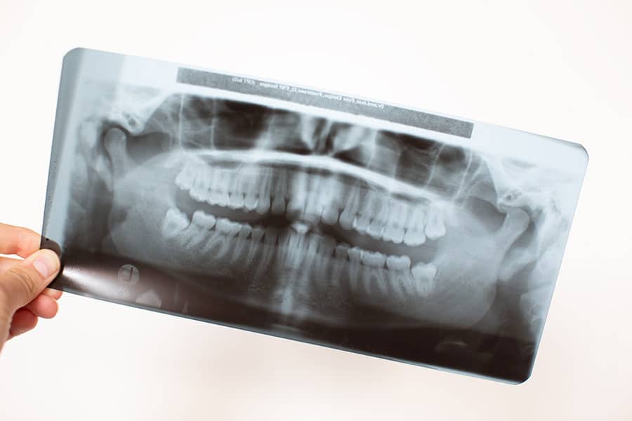 Weisheitszahn Röntgenaufnahme